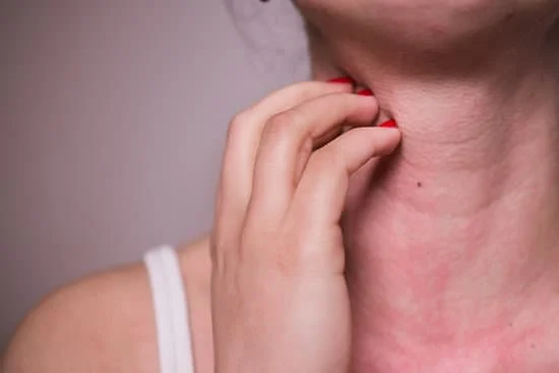 woman having an allergic reaction on her neck